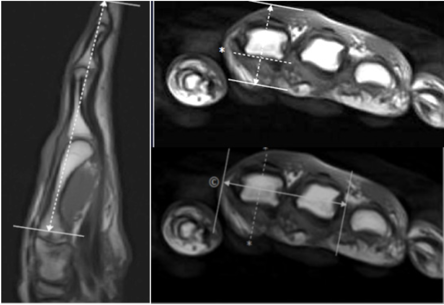 MR Finger (Not Thumb) WO and W/WO Protocol OHSU